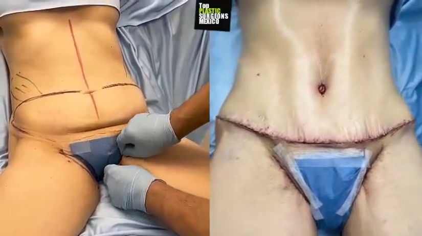 TUMMY TUCK + INNER THIGH LIFT